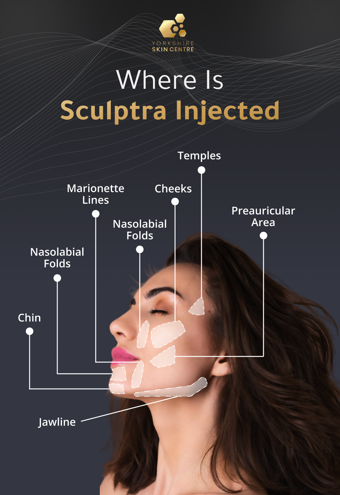 Infographic showing common Sculptra injection areas on the face, including temples, cheeks, nasolabial folds, marionette lines, preauricular area, chin, and jawline, with labelled diagrams highlighting each treatment zone.